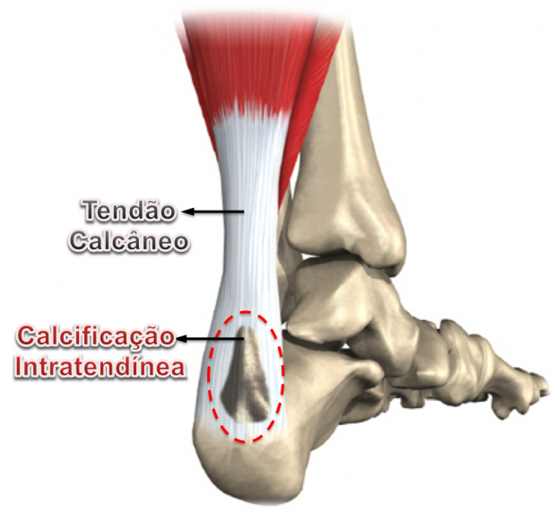 Dicas para evitar o esporão